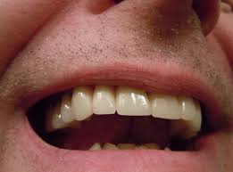 L Astuce Naturelle Pour Un Detartrage Des Dents Maison Astuces De Grand Mere Detartrage Des Dents Sante Bucco Dentaire Dentaire
