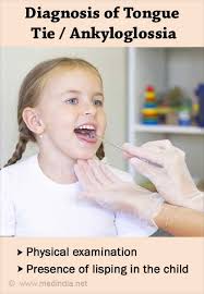 Image result for Ankyloglossia