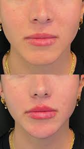 Come get Botox, lip and chin filler with me from the amazing  @injector_veronicak Best experience ever!