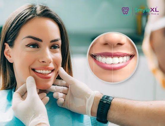 Smile Designing Treatment in Vanasthalipuram | SmyleXL Dental Clinic