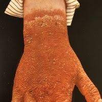 After reading this, most people may be wrongto understand, at what here. Pellagra Altmeyers Enzyklopadie Fachbereich Dermatologie