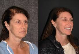 sixtyisthenewforty !!! Today I had a folllow up with this beautiful 64 year  old patient of mine 5 months after I performed her #plasticsurgery and she  looks amazing!!! I am excited by