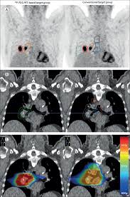 Weight loss is also almost universal, and it occurs even when people are eating a diet with adequate calories. Imaging Based Target Volume Reduction In Chemoradiotherapy For Locally Advanced Non Small Cell Lung Cancer Pet Plan A Multicentre Open Label Randomised Controlled Trial The Lancet Oncology