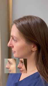 5 weeks post op minimally invasive rhinoplasty surgery! Still a little  swollen but will go down over time. DM us to schedule a free consultation.  #newyorkplasticsurgeon #longislandplasticsurgery ...