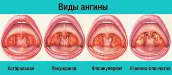 Ревматическая лихорадка после ангины: признаки и последствия
