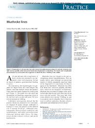 Image result for Muehrcke Line