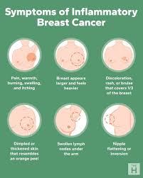 Image result for Inflammatory breast cancer