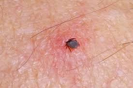 Pull it out slowly in a straight, steady motion. How To Tell If Tick Head Is Still In Skin And How To Get It Out