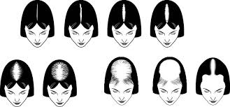 hair transplantation procedures can help women as well as