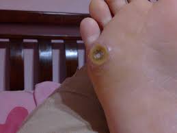 Biasanya, vesikel dianggap jinak, tetapi kadang kala menjadi ganas. Ubat Untuk Ketuat Di Kaki Pertanyaan C