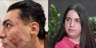 Justiça decide se Natália Becker vai a júri popular por morte em peeling de  fenol