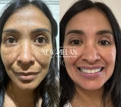 ✨ ¡Dile adiós al melasma con NewMelan del Dr. Eduardo Krulig! ✨ ¿Las  manchas afectan tu piel y tu confianza? Con NewMelan del Dr. Eduardo  Krulig, recupera la belleza natural de tu