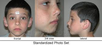 They usually disappear completely when the nasal bridge develops completely. Photo Instruction