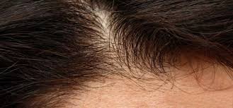 One of the most common reasons for burned hair is the use of curling irons, straighteners or any. Fix Burnt Hair After Diwali