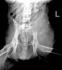 It is the most common cancer in teenagers and young adults, but in fact more than half of cases of sarcoma it most commonly affects the pelvis, shoulder blade (scapula), ribs, and the bones of the upper parts. Bone Tumors Pelvic Dr Julius Liptak