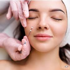 Reshape Your Nose with PDO Thread Nose Lift at S2G Medical Spa