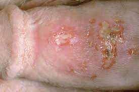 When a person is suffering from this disease then the all these symptoms occur in an infected person but sometimes a person can have this disease without showing any specific hsv 2 symptoms, and. What Does Herpes Look Like Pictures Treatment And Prevention