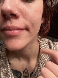Can someone please tell me what these lumps are beside my mouth? (PhotO)