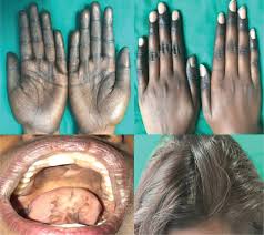 High levels of homocysteine, which are linked with heart attack, stroke, and alzheimer's disease. Mucocutaneous Hyperpigmentation As Presentation Of Vitamin B12 Deficiency A Case Report And Brief Review Agrawal Pv Sharma Yk Deo Ks Ranpariya Rh Singh P Pigment Int