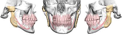 Franceschetti syndrome synonyms, franceschetti syndrome pronunciation, franceschetti syndrome translation, english dictionary definition of franceschetti syndrome. Medizinische Hochschule Hannover Kiefergelenkchirurgie