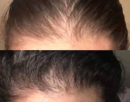 In the last couple of years, biotin supplements have become the rave. This Biotin Shampoo S Before And After Photos Will Have You Believing In Miracles