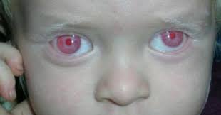 Do any humans have purple or blue eyes and/or skin?