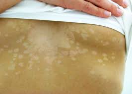 This is then followed, days to weeks later, by a rash of many similar but smaller round or oval lesions, mainly on the trunk and upper limbs. Tinea Versicolor Wikipedia