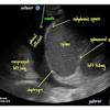 It does tell you that it's going to be more difficult to do a thoracentesis, to actually drain the fluid, and ultrasound is going to be much better at determining. 1