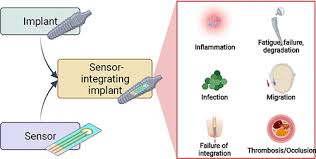 Implants with Sensing Capabilities ...
