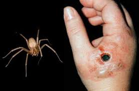 Araña violinista, características y prevención. Dr Rafael Alberto Briseno Vazquez Picadura De Arana Violinista