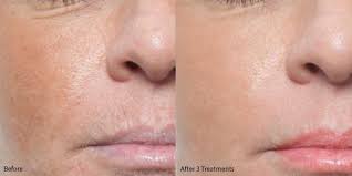 Aesthetics Microneedling Skin Tightening Wrinkles