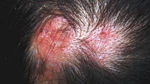 Find out about treatment and how you can ease your symptoms. A Closer Look At Lupus Pictures
