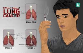 Anytime you cough up bloody phlegm, it should be a warning sign that something is wrong. Lung Cancer Symptoms Causes Treatment Medicine Prevention Diagnosis