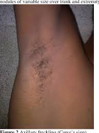 However, there are multiple lesions, usually more than five and fewer than 10. A Case Of Neurofibromatosis Type1 With Coexisting Borderline Tuberculoid Leprosy Semantic Scholar