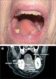 A Deviated Tongue The Lancet