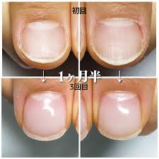 広がった爪】丸爪・男爪から縦長爪へ！！どのくらいで変化したかお見せします！ | 京都市桂川ネイルサロン 爪の悩みにサヨナラ！コンプレックス爪を美爪へと導く  ティンクネイル