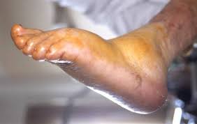 Er tritt vor allem im rahmen einer diabetischen neuropathischen osteoarthropathie (dnoap) auf. Diabetisches Fusssyndrom Teil 1 Springerlink