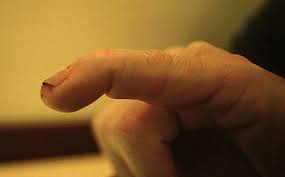 Mallet fractures involve avulsion of the dorsal base of the distal phalanx with the attached extensor the ideal treatment for a mallet finger fracture which involves more than one third of the articular. Mallet Finger Litfl Trauma Library