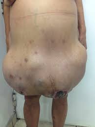Image result for Ascites