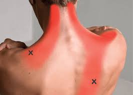 Image result for Tender Point