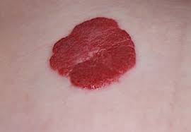 Gemangioma Vikipediya