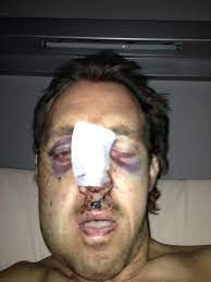 De bekende ondernemer liep zeventien breuken in het gezicht op, nadat een andere jetski frontaal op hem was ingevaren. Bart Versluys On Twitter Foto Na Ongeval Http T Co W0cqf4pz1y