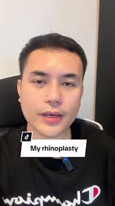 My Rhinoplasty Experience After 15 Days