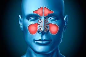 Sinus infections caused by a deformity, a blockage in the nasal passages, or allergies are not. Sinus Infections Are They Contagious Alihamdan Id