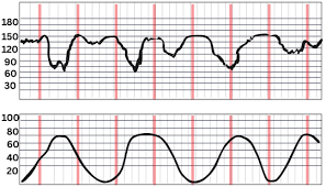 Image result for Early Deceleration