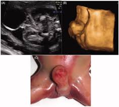 Image result for Labial Fusion