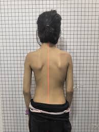 كيف يؤثر العمر على دقة تشخيص اعوجاج العمود الفقري؟