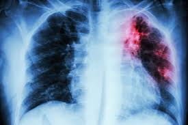 Others are asthma, chronic obstructive pulmonary disease, infections like influenza, pneumonia and tuberculosis, lung cancer, and many other breathing problems. I Got Tuberculosis And Spent 20 Days In Isolation Health Com