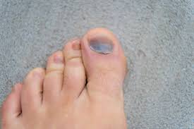 Image result for Pitting nails feet