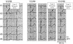 In how long can you go without food and water?, we learned that humans can last only three to five days without. Brugada Syndrome From Cell To Bedside Sciencedirect